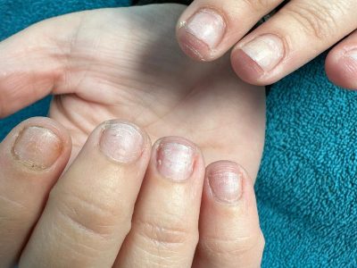 uñas antes de la manicura y reconstrucción